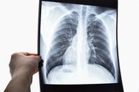 Nuevos abordajes terapéuticos en estadios precoces de cáncer de pulmón