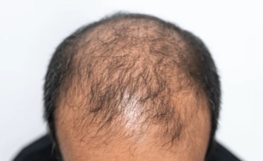 vacuna alopecia
