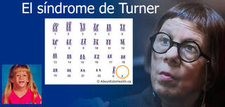 El síndrome de Turner