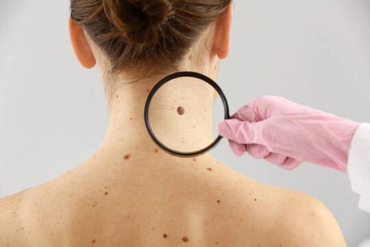 Últimos avances en el manejo del melanoma avanzado