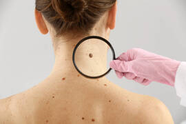 Últimos avances en el manejo del melanoma avanzado