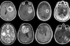 Más de 5.000 nuevos casos de tumores cerebrales diagnosticados anualmente en España