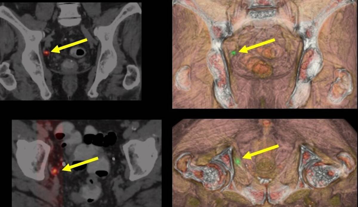PET-CT PSMA: recidiva ganglionar del cáncer de próstata.