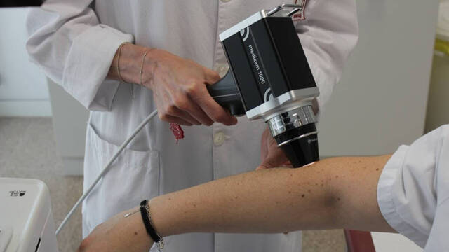 Avisan de la importancia del control de lunares para detectar un posible cáncer de piel 